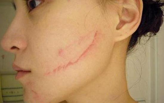 啤酒瓶爆炸，女服務(wù)員臉上留疤，餐廳和啤酒經(jīng)銷商都拒賠